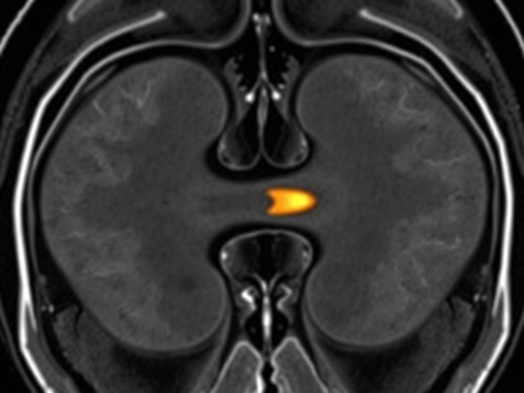 MRI scan of a minipig joint highlighting regenerated cartilage surface
